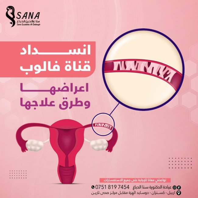 انسداد قناة فالوب