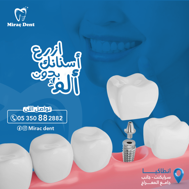 زراعة الاسنان
